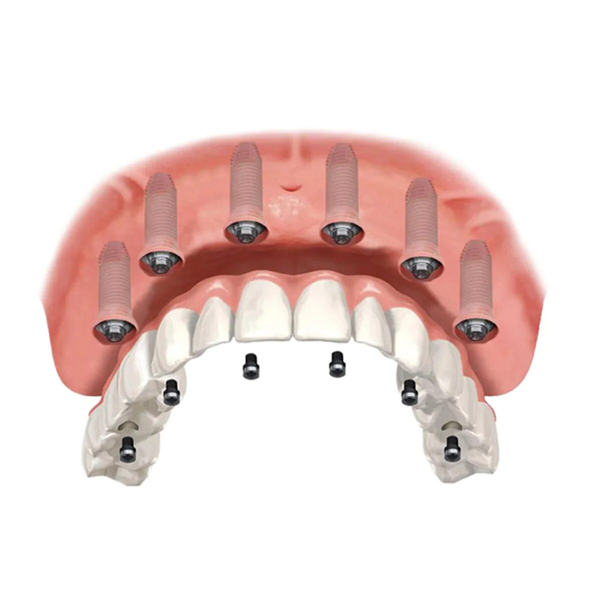 Имплантация зубов all on 6. Имплантологическая кассета Nobel полный набор для all on 4. Имплантация зубов по технологии all-on-6 ("все на шести").. Имплантация челюсти на 6 имплантах.