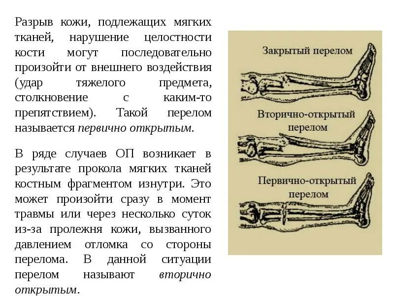 Разрыв кости. Открытый перелом первичный и вторичный. Первично и вторично открытый перелом. Первично открытые и вторично открытые переломы.