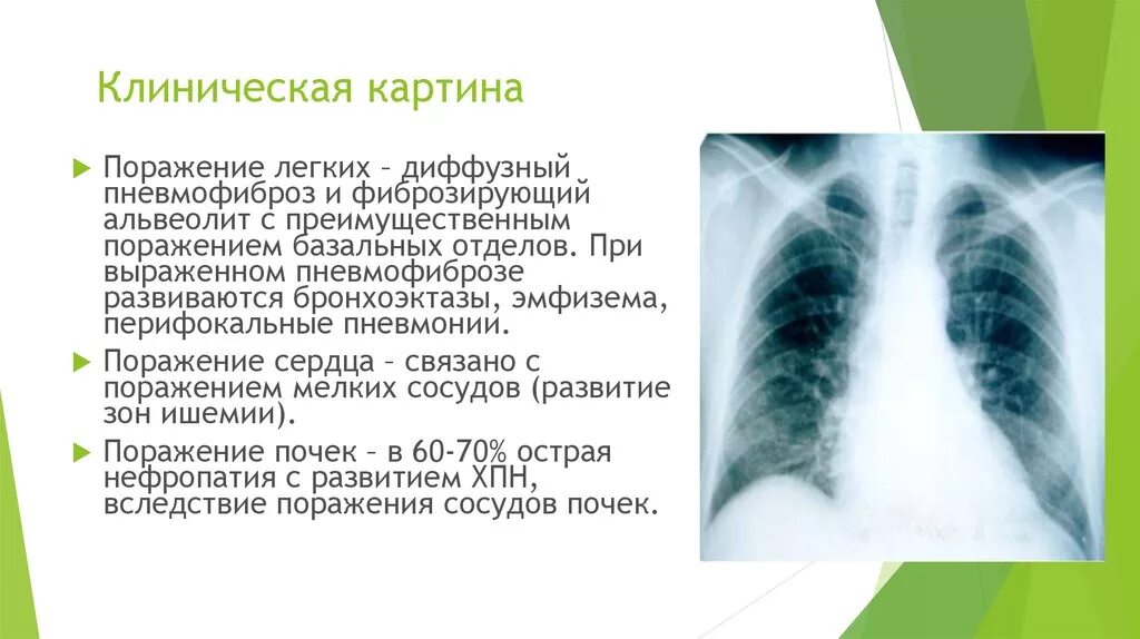 Диффузный пневмофиброз легких что это такое. Метапневмонический пневмофиброз что это. пневмофиброз s5 правого лёгкого. субплевральный пневмофиброз.
