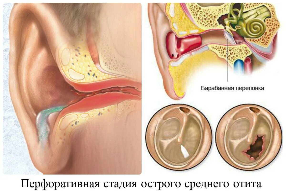 Утром болят уши. Острый Гнойный средний отит барабанная перепонка. Гнойный отит барабанная перепонка.