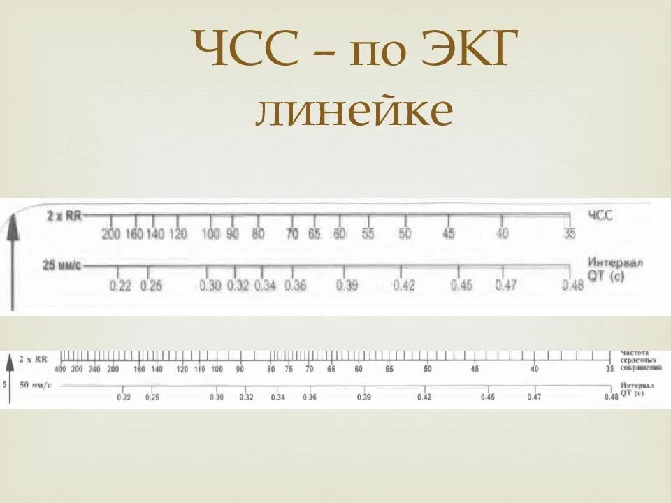 Как определить чсс по экг. Подсчёт чсс по экг 25 мм. линейка для измерения чсс на экг. линейка для подсчета чсс в экг. измерение чсс по линейке на экг.