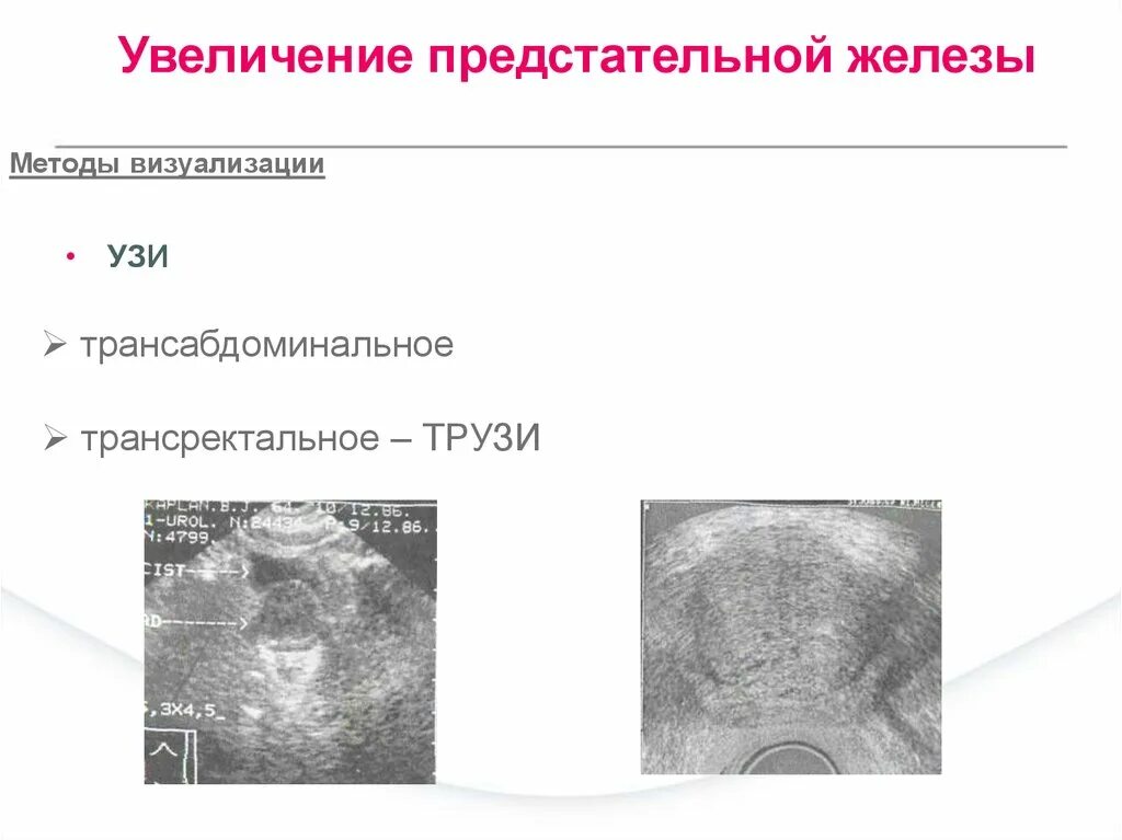 Восстановление предстательной железы. Многоузловая гиперплазия предстательной железы что это. Трансректальное УЗИ предстательной железы. Аденома предстательной железы на УЗИ. Трансабдоминальное исследование предстательной железы.