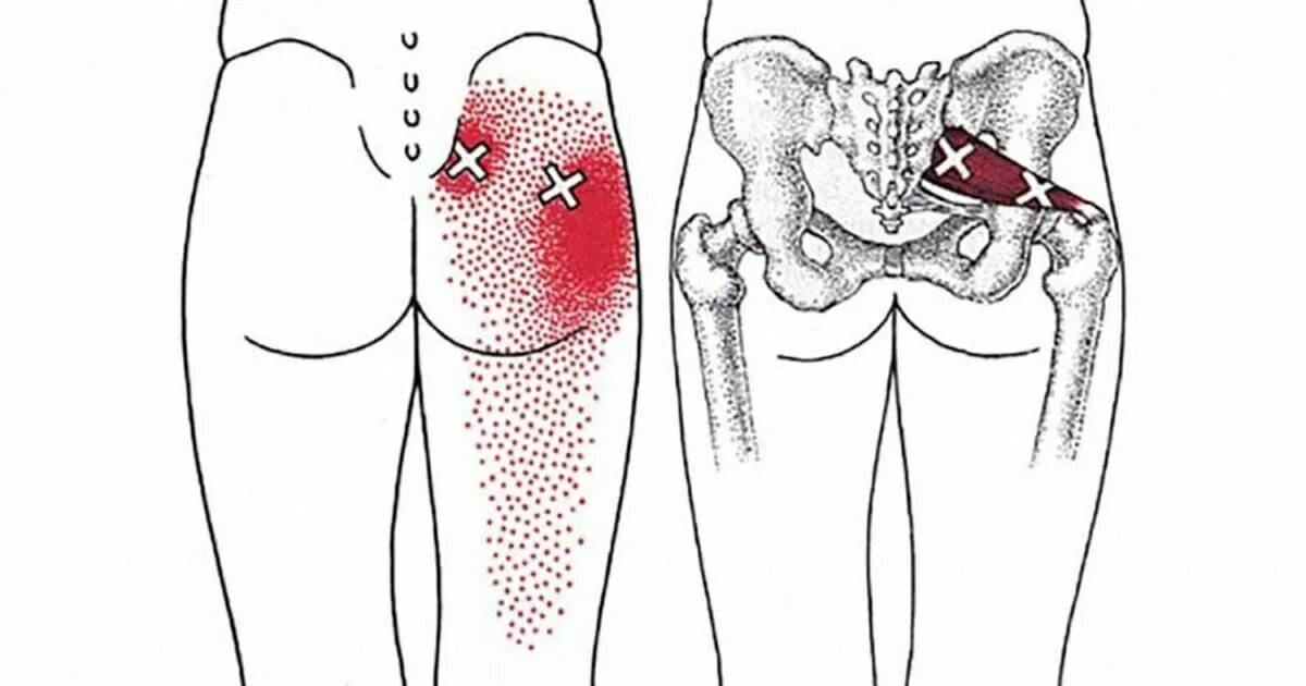 Боли ниже поясницы отдающие в ноги. Миофасциальный синдром грушевидной мышцы. Миофасциальный синдром бедра. Боль в пояснице отдающая в ягодицу.