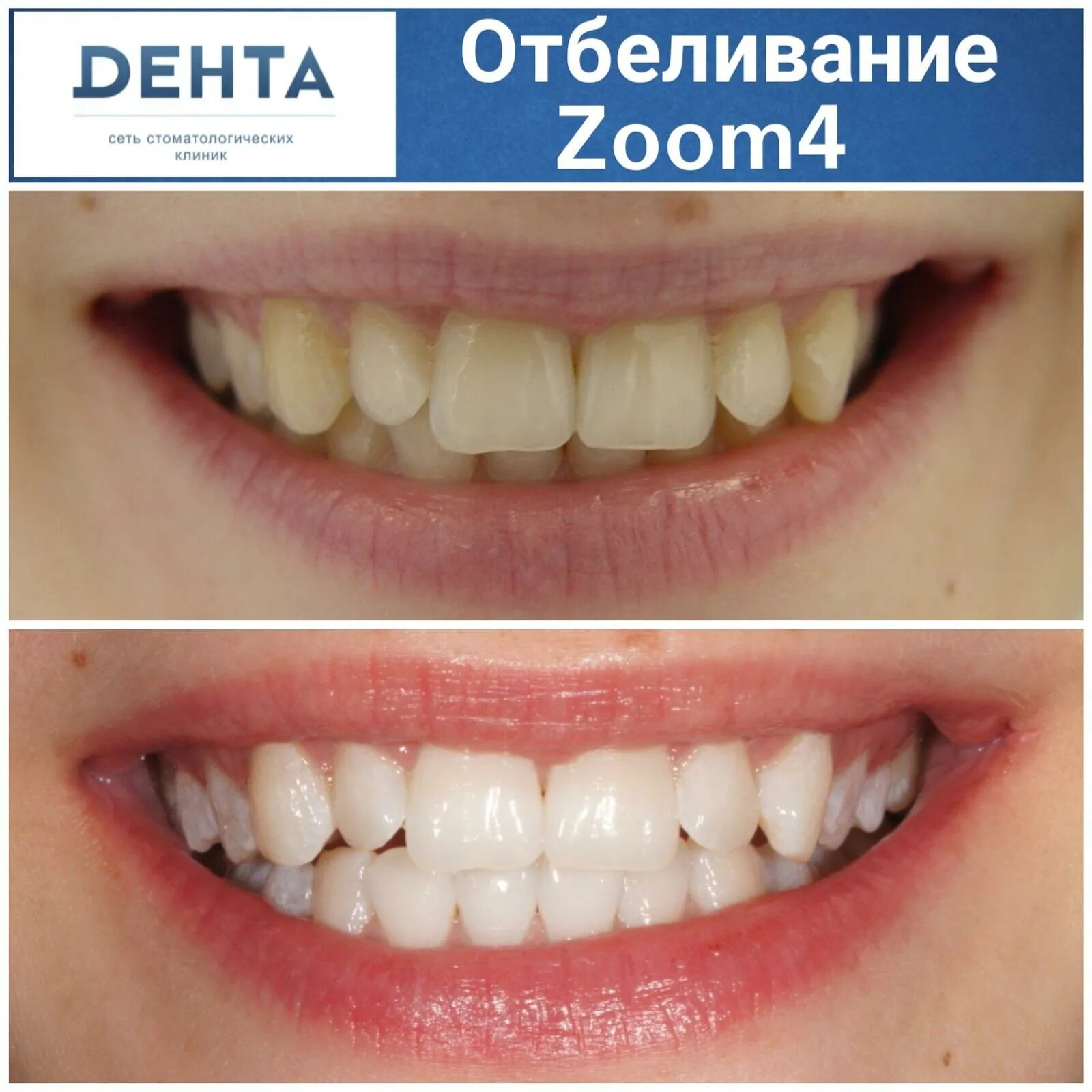 Отбеливание зубов результат. Зубы до и после отбеливания.