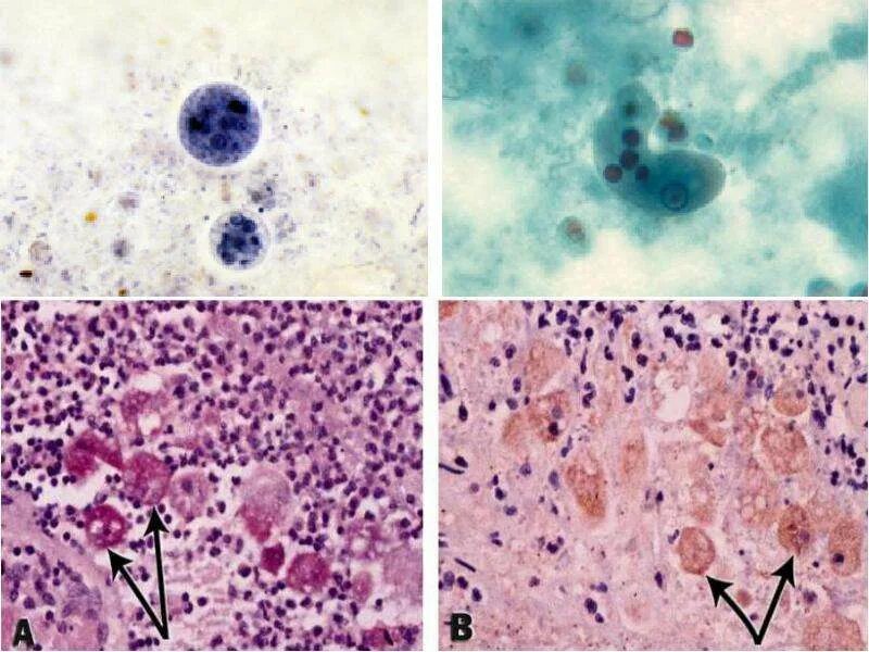Хламидии трихомонады микоплазма. Гистомоноз трихомоноз. Трихомониаз микроскопия. Гистомоноз кур микроскопия. Гистомоноз микроскопия.