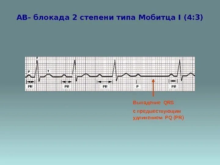 Атриовентрикулярная блокада 2. АВ блокада 2 степени Мобитц 3 на ЭКГ. АВ блокада 3 на ЭКГ. ЭКГ АВ блокада 1. Атриовентрикулярная блокада Мобитц 2.