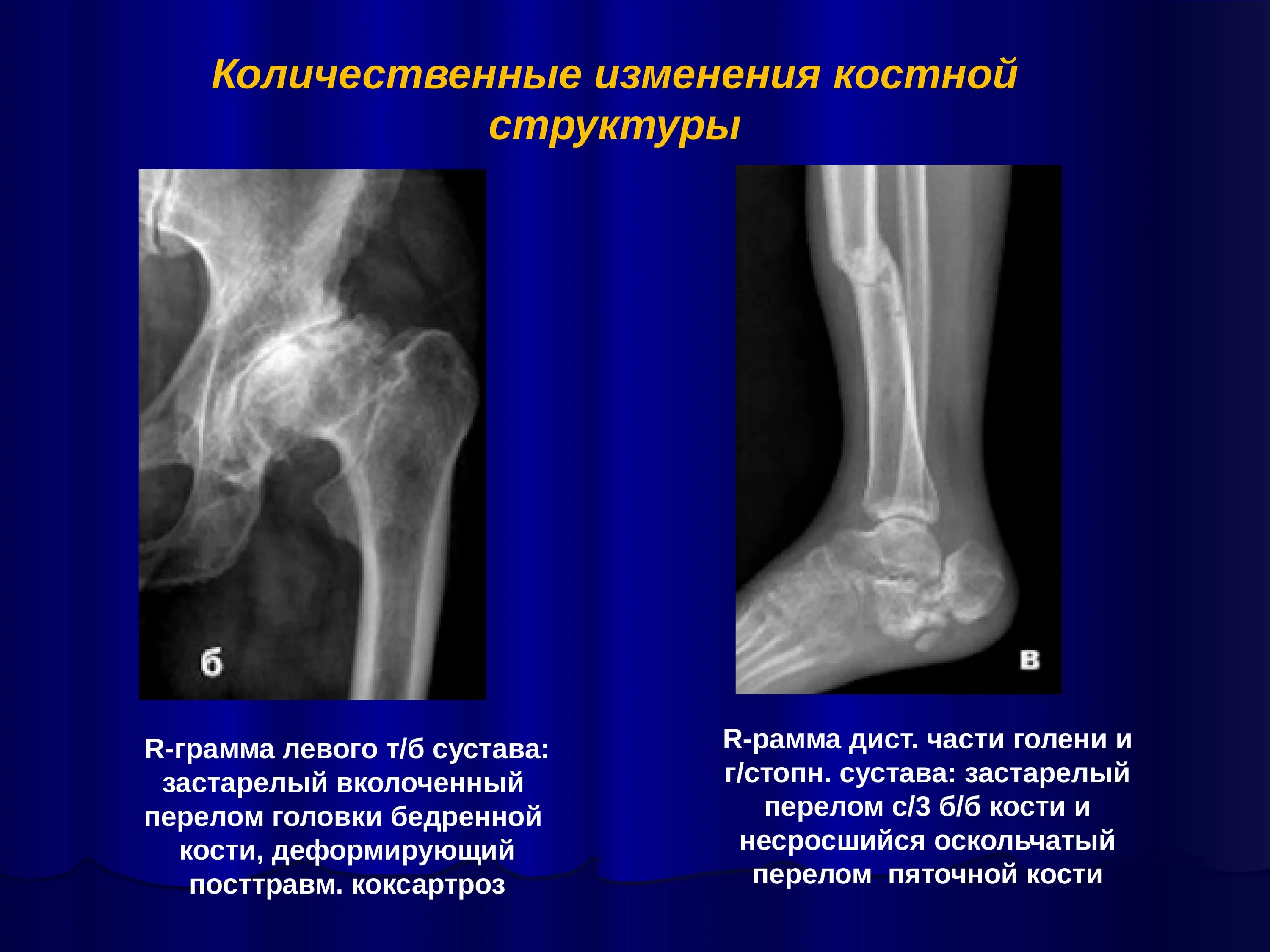 Диагноз перелома лучевой кости. Застарелый перелом коленного сустава рентген. Вколоченный перелом кости. Переломы рентгенология. Переломы пяточных костей рентгенодиагностика.