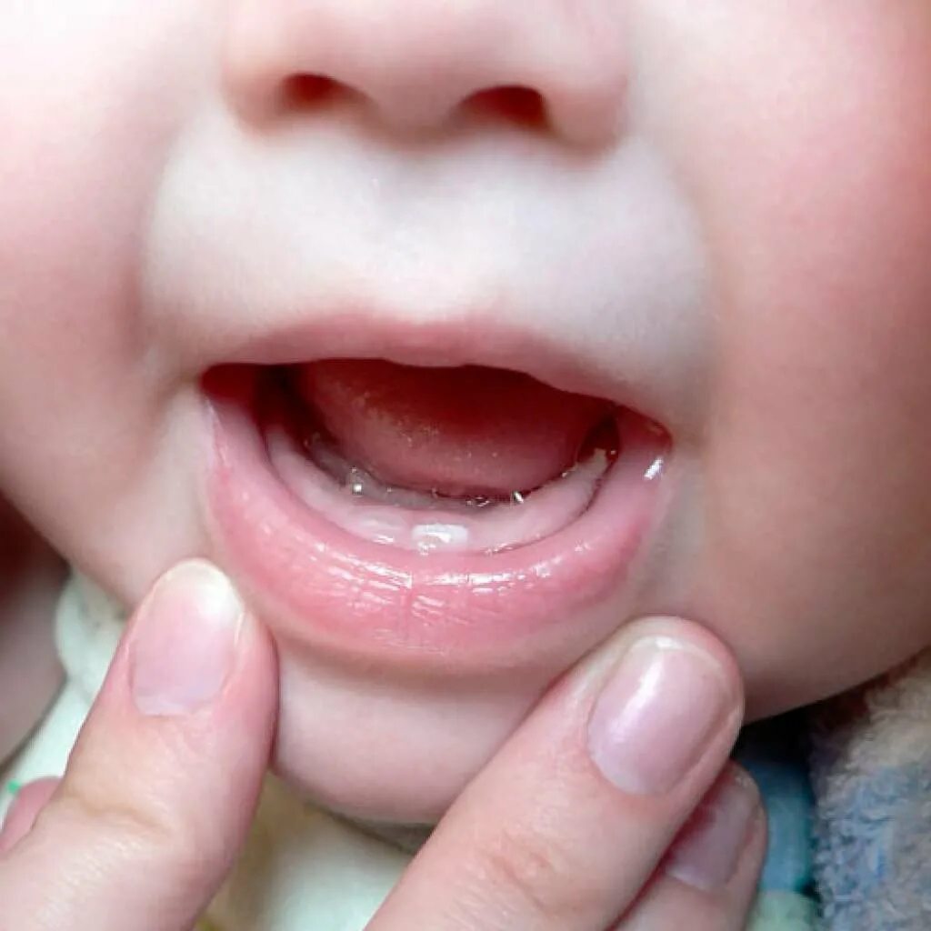 Прорезывание зубов у детей. Десна при прорезывании зубов. Во сколько у ребенка появляются зубы