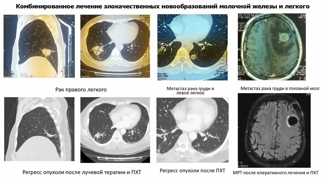 Метастазы после химиотерапии