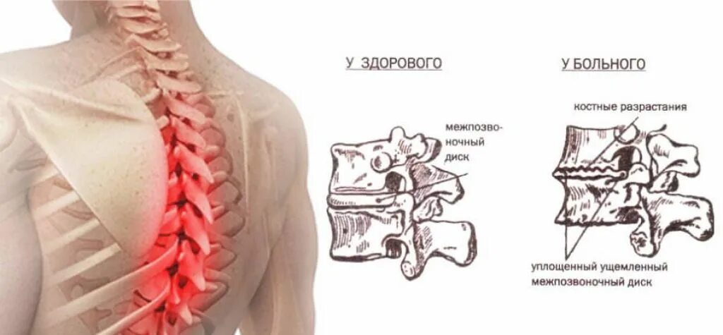Остеохондроз грудного отдела позвоночника симптомы. Остеохондроз среднегрудного отдела позвоночника. Остеохондроз th5-th8. Межпозвонковый остеохондроз грудного отдела.