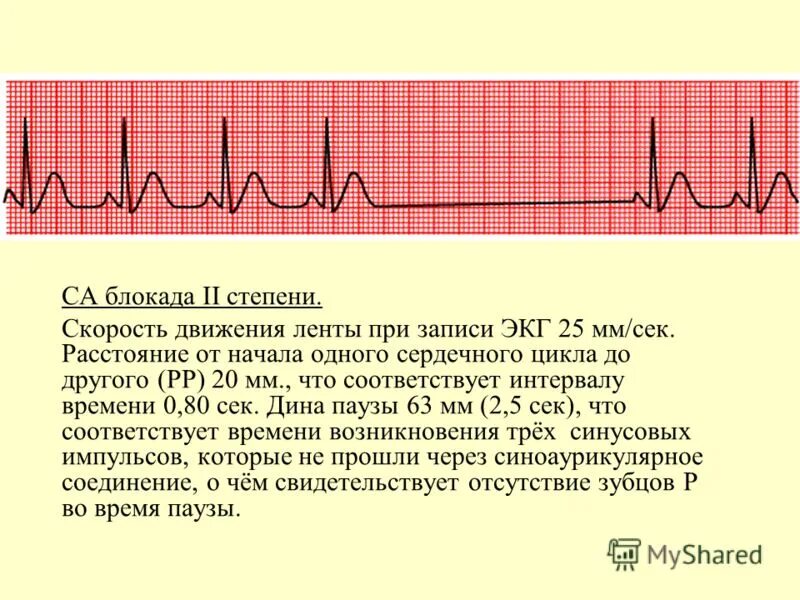 Са блокада 1 степени. Синоатриальная блокада 2 степени на ЭКГ. ЭКГ при синоатриальной блокаде 2 степени. Синоатриальная блокада 1 степени на ЭКГ. Синоатриальная блокада 3 степени на ЭКГ.