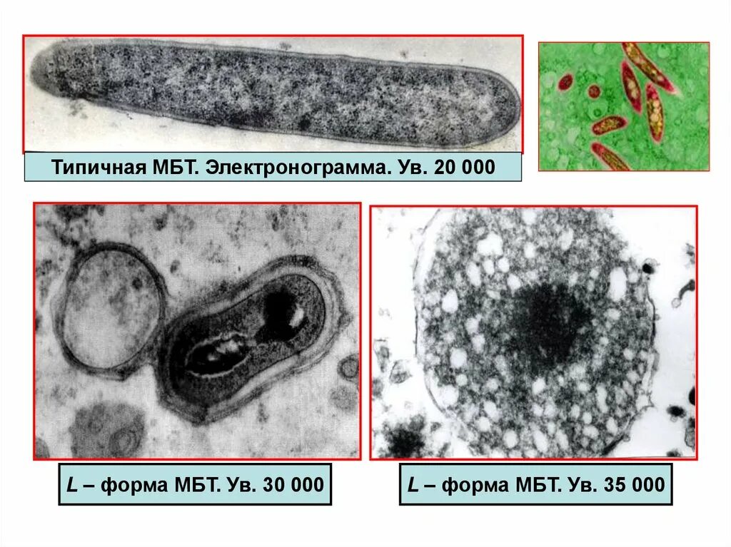 Л формы микобактерии туберкулеза. L форма микобактерии туберкулеза это. Микобактерия туберкулеза (МБТ). Микобактреия туберкулёз.