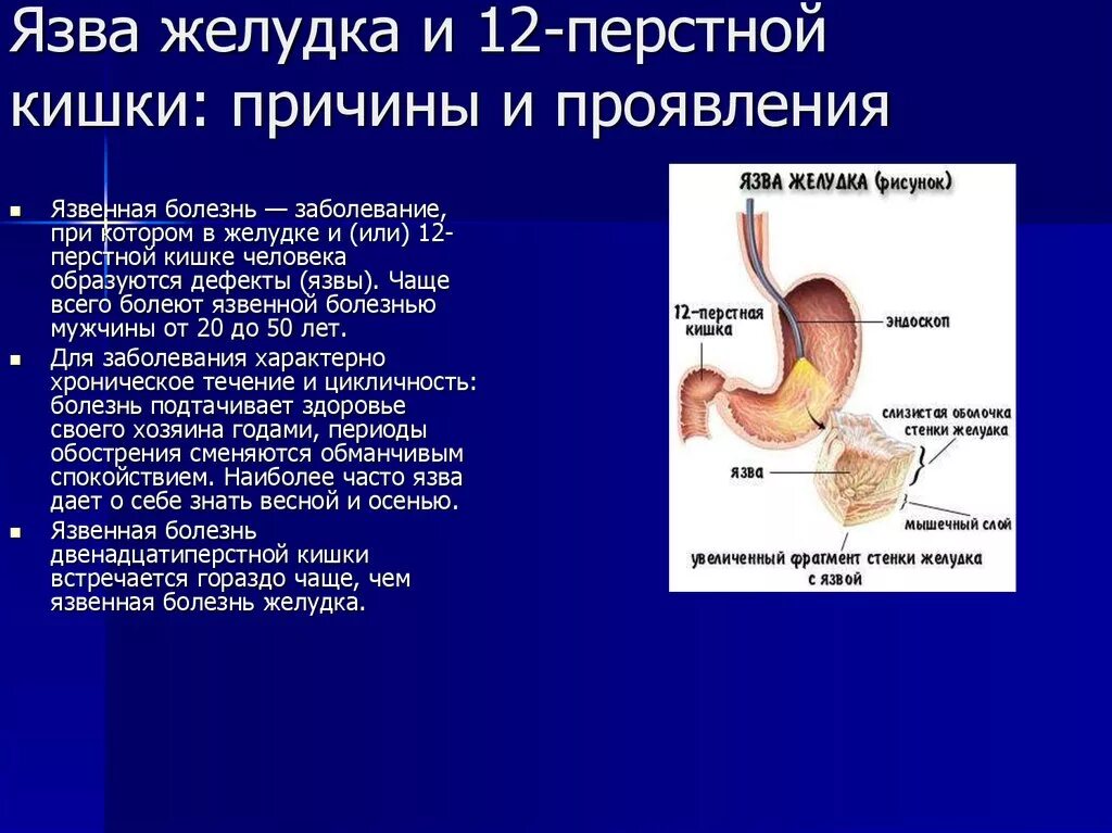 Язв болезнь 12 перстной кишки