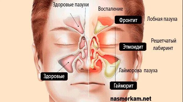 Где болят пазухи. Ппн на рентгене двухсторонний гайморит. Где болят пазухи. Где болят пазухи. Где болят пазухи.