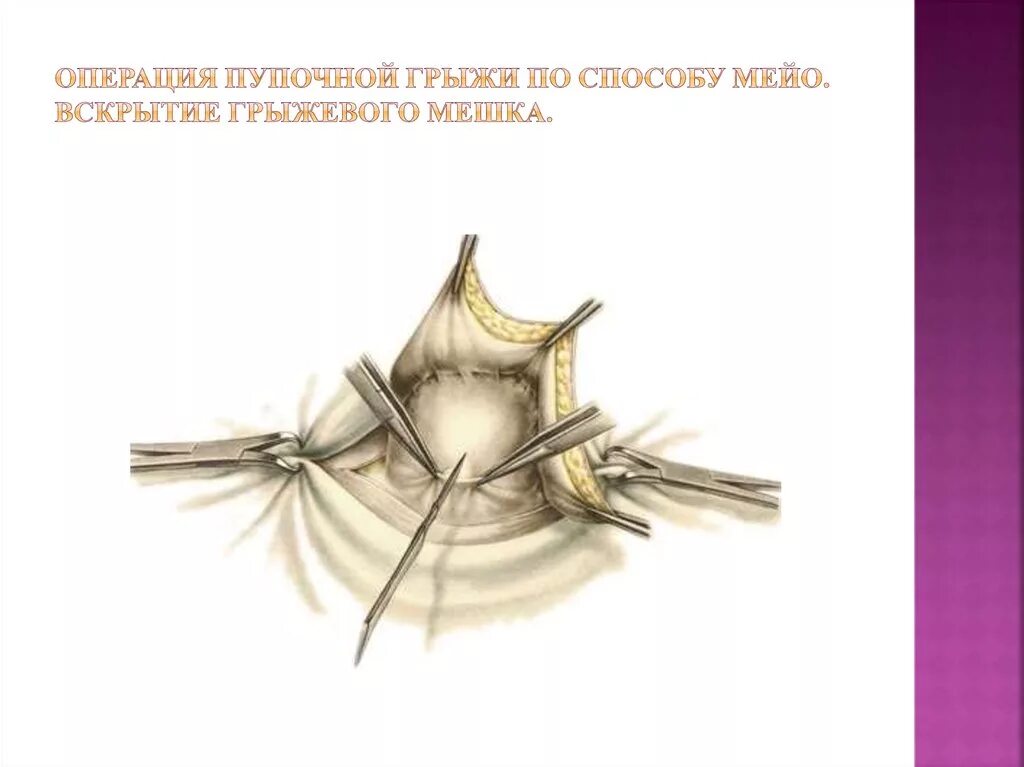 Операция лексера при пупочной грыже. Операция пупочной грыжи питание. Пластика пупочной грыжи местными тканями. Пупочная грыжа по мейо. Операция при ущемленной грыже пупка.