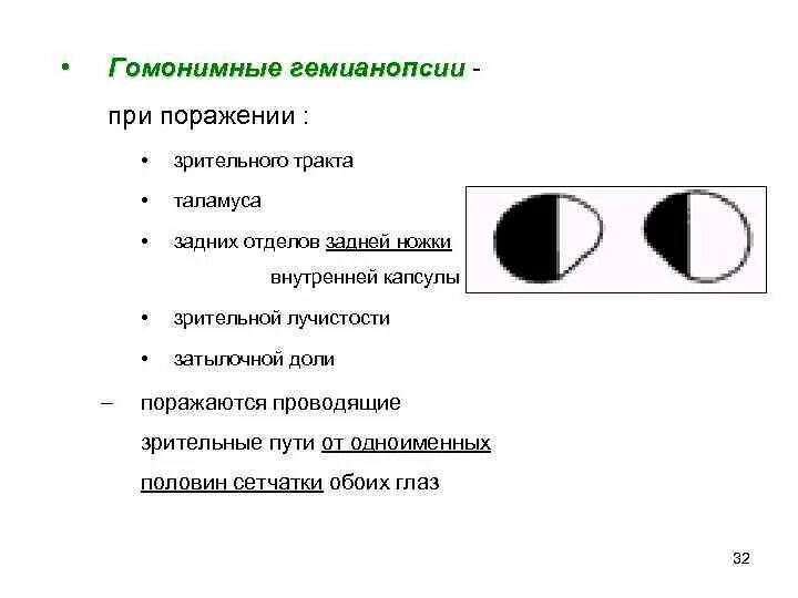 Поля зрения гемианопсии. Правосторонняя гомонимная гемианопсия. Гомонимная правосторонняя гемианопсия очаг поражения. Левосторонняя гомонимная гемианопсия очаг поражения. Монимен