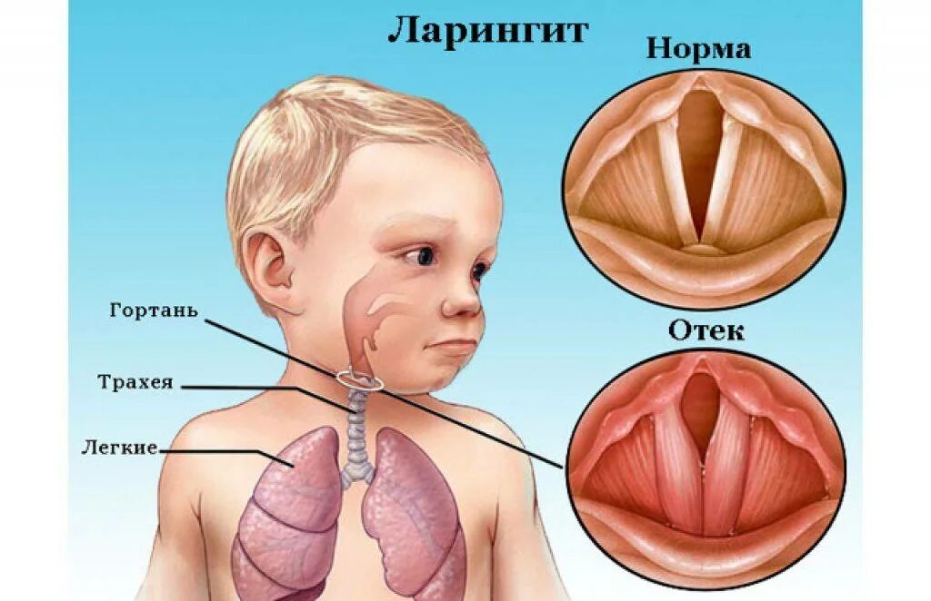 Детская гортань. Острый отечный ларингит.