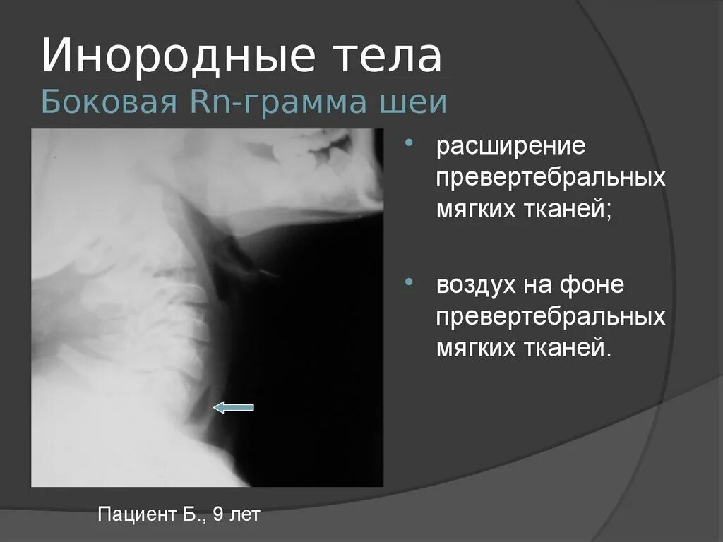 Тело пищевода. Инородные тела пищевода. Инородное тело мягких тканей. Инородное тело в мягких тканях на рентгене. Инородные тела пищевода рентгенограммы.