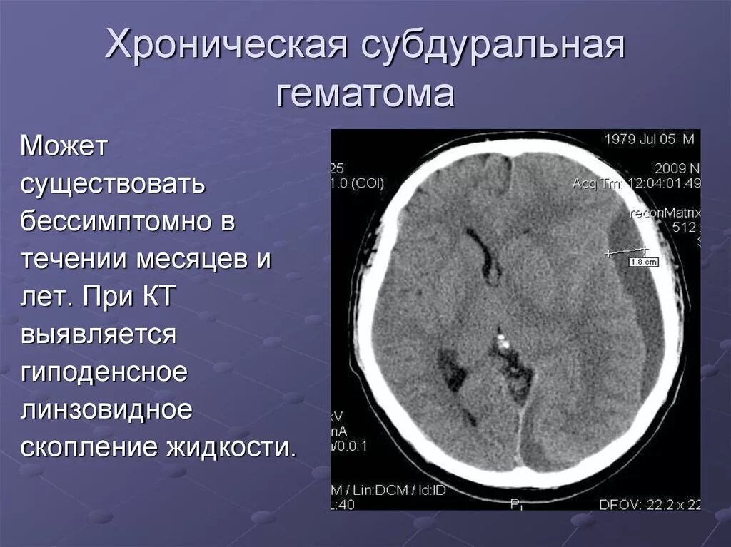 Хронические субдуральные гематомы на кт. Субдуральная гематома головного мозга кт. Хроническая субдуральная гематома на кт. Конвекситальная субдуральная гематома. Гематома в стадии организации