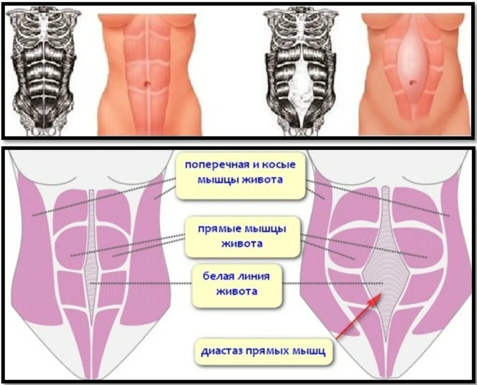 Мышцы живота во время беременности. Расхождение мышц живота диастаз. Мышцы пресса анатомия диастаз. Мышцы живота во время беременности. Диастаз прямой мышцы живота.