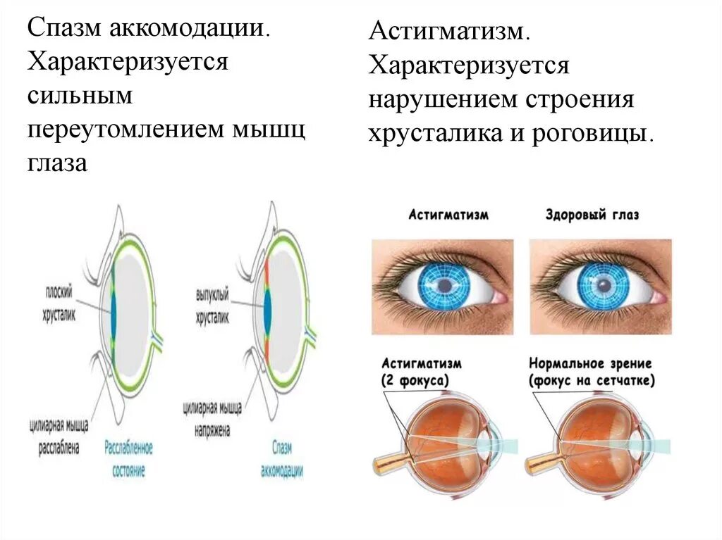 Какая структура обеспечивает аккомодацию. Хрусталики глаза строение глаза. Аккомодация симптомы. Спазм аккомодации глаз. Спазм аккомодации ложная близорукость.