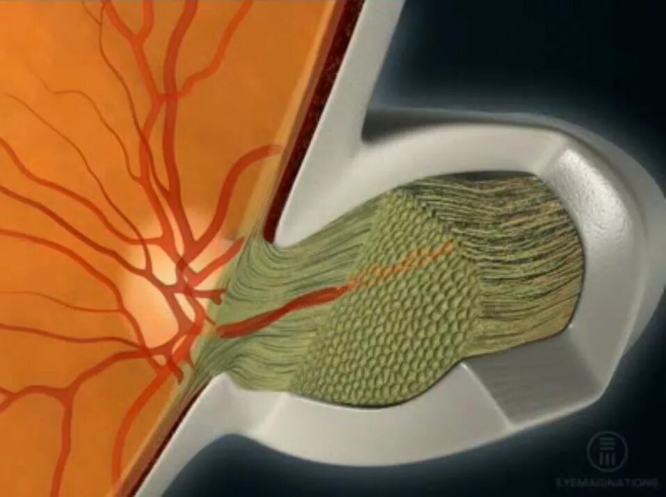 Зрительный нерв под микроскопом. Сетчатка и зрительный нерв. Глазной нерв под микроскопом.