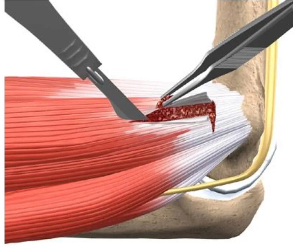 Сколько заживает сухожилие. Локоть теннисиста латеральный эпикондилит. Латеральный эпикондилит сухожилие. Медиальный эпикондилит сухожилия. Медиальный эпикондилит локтевого.
