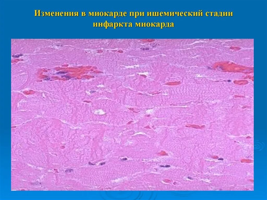 Инфаркт гистология. Ишемический инфаркт миокарда микропрепарат. ишемический инфаркт миокарда макропрепарат. инфаркт миокарда микропрепарат. донекротическая стадия инфаркта миокарда гистология.