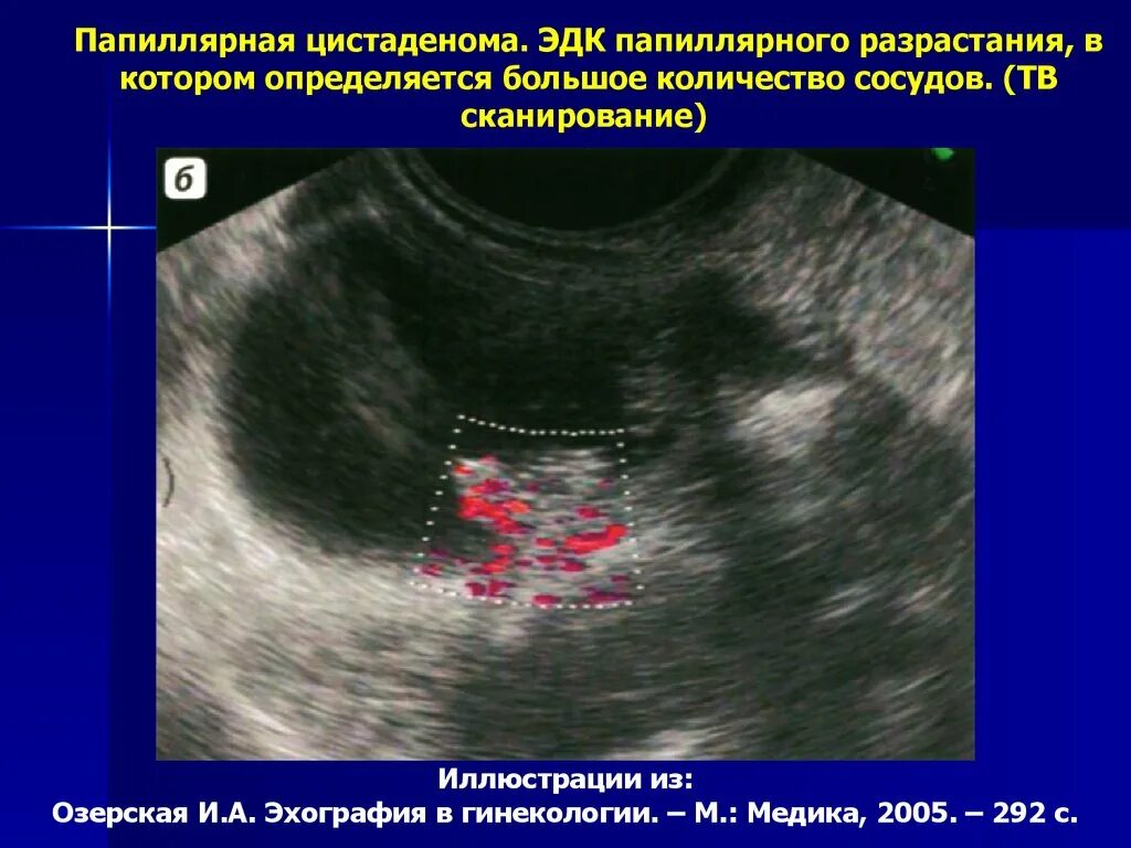 Папиллярная цистаденома гистология. Папиллярная кистома яичника. Гранулезоклеточная опухоль УЗИ. Серозная пограничная опухоль