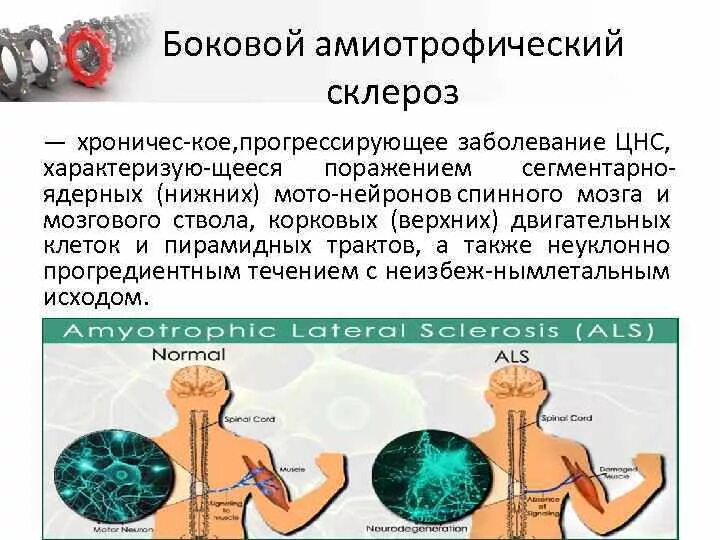 Боковой амиотрофический склероз причины заболевания. Амиотрофический склероз. Боковой амиотрофический. Бас боковой амиотрофический склероз. Боковой склероз.