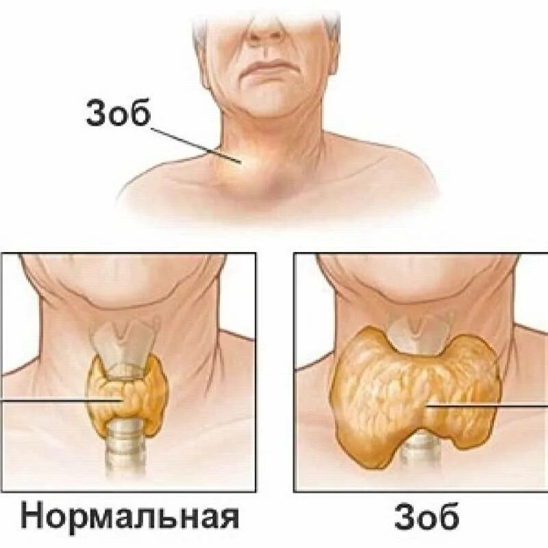 Эндемический зоб щитовидной. Многоузловой эндемический зоб. Узловой зоб 2 степени щитовидной железы симптомы. Узловой эндемический зоб.