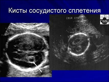 Киста голова новорожденный узи
