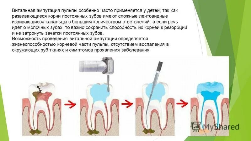 методы лечения пульпита тесты. методы лечения пульпита у детей. методы лечения пульпита тесты. методы лечения пульпита тесты. классификация способов лечения пульпита.