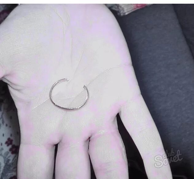 Отпечаток от кольца на пальце. Сломалось кольцо. Отекший палец и обручальное кольцо.