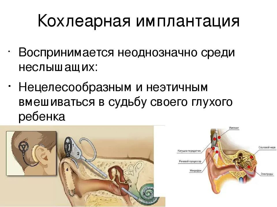 Операция на ухо на слух. Кохлеарная имплантация при нейросенсорной. Операция по кохлеарной имплантации. Слуховой аппарат кохлеарный имплант операция. Аппарат для глухих кохлеарная имплантация.