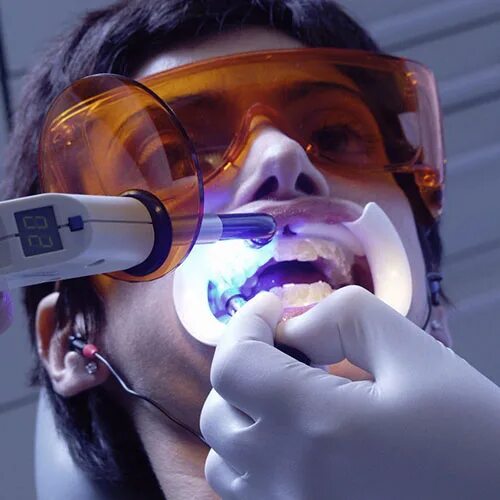 Зубной сегодня. Лазерные лампы в стоматологии. Фотодинамическая терапия зубов. Лазерный метод чистки зубов в стоматологии.