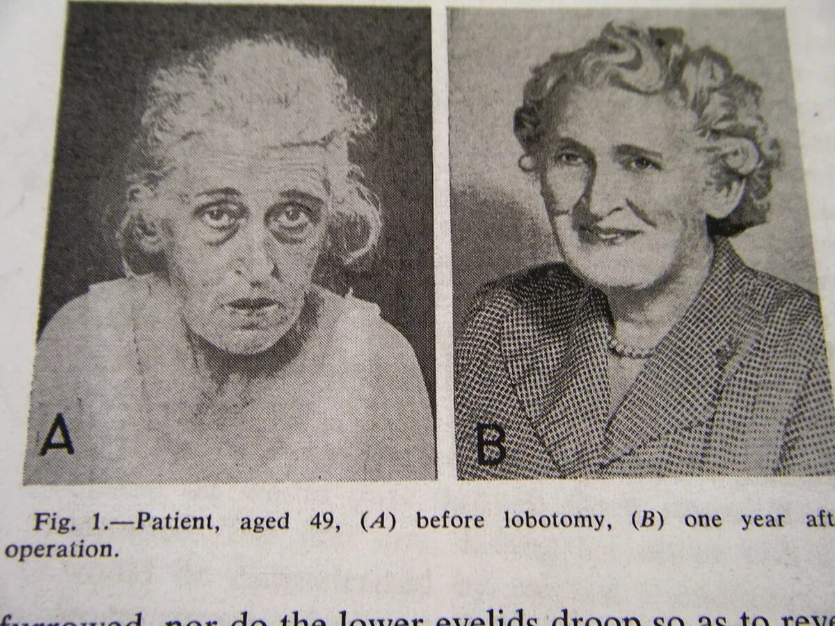 Фото людей после лоботомии. Лоботомия фото до и после пациентов.