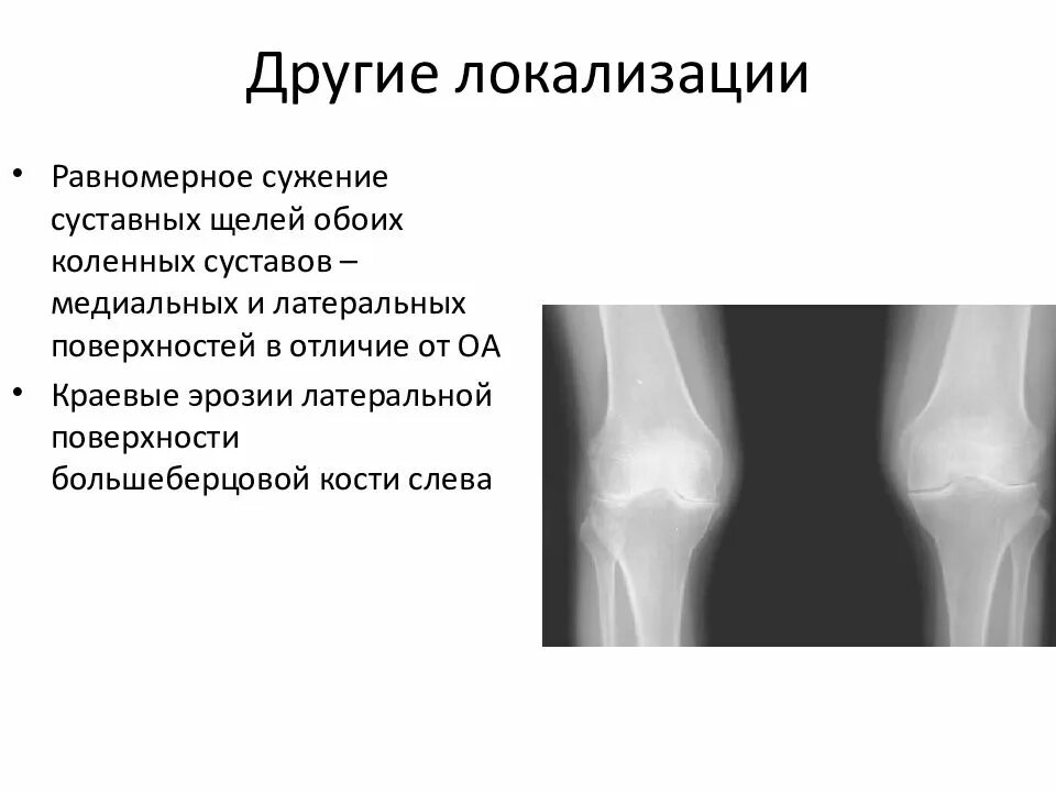 Краевые костные заострения суставных поверхностей. Суставная щель 5мм коленный сустав. Суставная щель коленного сустава 3мм. Ревматоидный артрит сужение суставной щели. Сужение коленных суставов