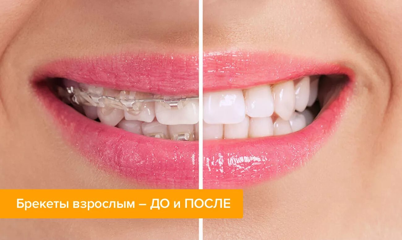 Зубы после 30. Керамические брекеты до и после.