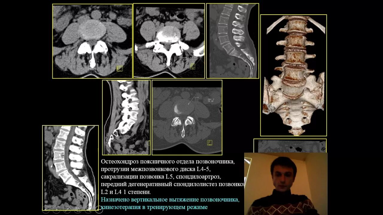 Дегенеративные поражения позвоночника. Дегенеративные изменения позвонков кт. Остеохондроз поясничного отдела кт. Дегенеративные изменения позвоночника на кт. Дегенеративные изменения поясничного отдела позвоночника кт.