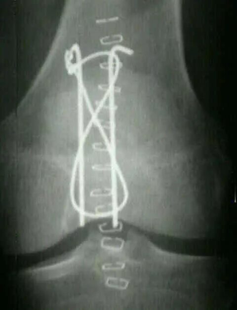 Перелом надколенника остеосинтез. Остеосинтез надколенника проволокой. Остеосинтез надколенника по Веберу. Остеосинтез надколенника по Веберу рентген. Перелом надколенника операции