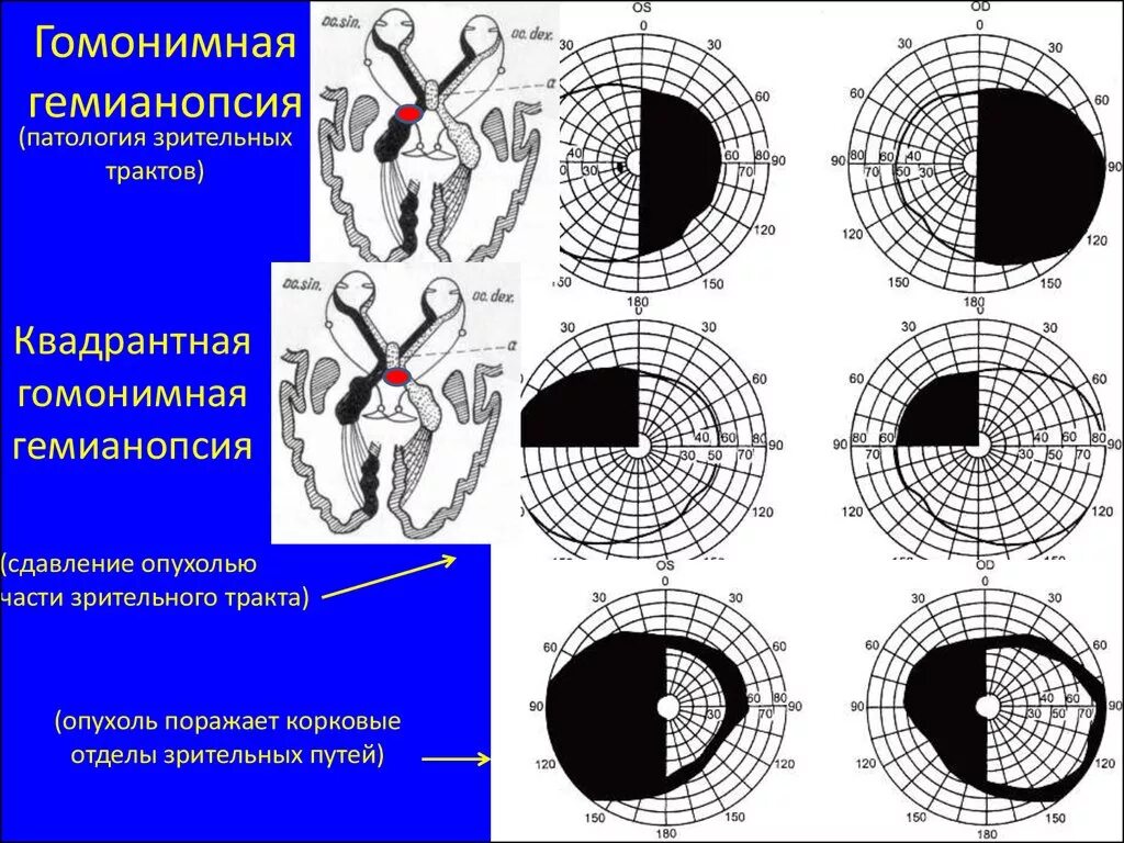 Гетеронимная гемианопсия. Нижнеквадрантная гемианопсия. Гомонимная правосторонняя гемианопсия очаг поражения. Правосторонняя гетеронимная гемианопсия.