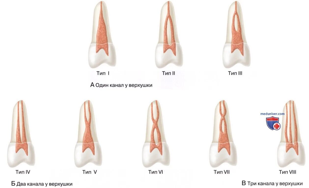Типы корневых каналов по Вертуччи. Классификация каналов Вертуччи. Типы корневых каналов по Vertucci. Формы корневых каналов