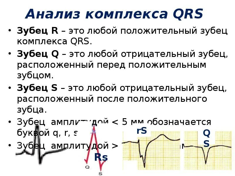 Отрицательный комплекс QRS В 3 отведении на ЭКГ. Комплекс QRS на ЭКГ W. Комплекс зубцов QRS на ЭКГ. Отрицательный комплекс QRS на ЭКГ.