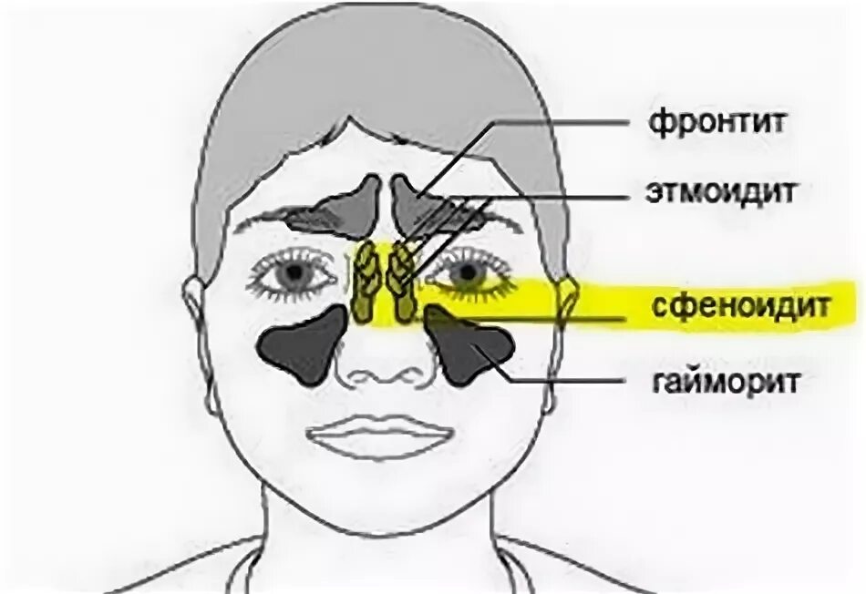 Сфеноидит форум. Синусит фронтит этмоидит сфеноидит. Острый сфеноидит симптомы.