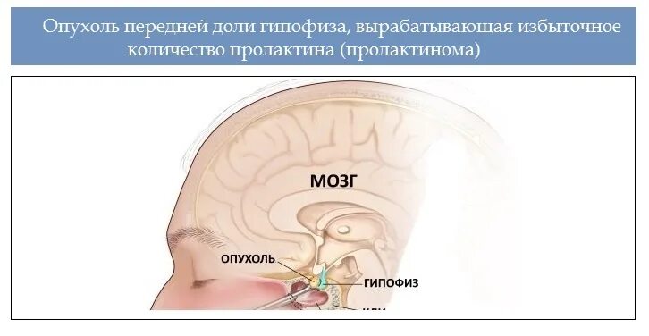 Опухоль гипофиза. Опухоль вырабатывающая пролактин. Пролактин и опухоль головного мозга. Пролактин продуцирующие опухоли гипофиза. Гипофиз пролактин симптомы.