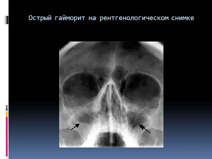 Острый верхнечелюстной синусит на рентгене. Киста верхнечелюстной пазухи рентген. Двухсторонний гнойный