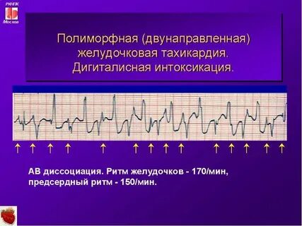Интоксикация на экг