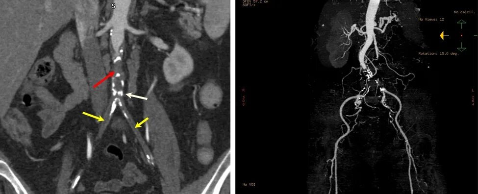 Тромбоз брюшной. Тромбоз бифуркации аорты клиника. Тромбоз подвздошной артерии кт. Синдром Лериша ангиография. Тромбоз брюшной аорты кт.