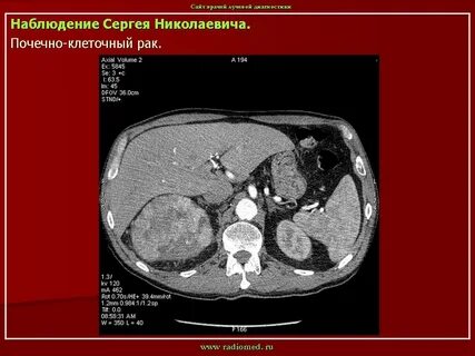 Метастазы в почки сколько живут